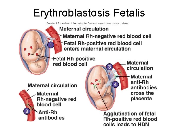 Erythroblastosis Fetalis 