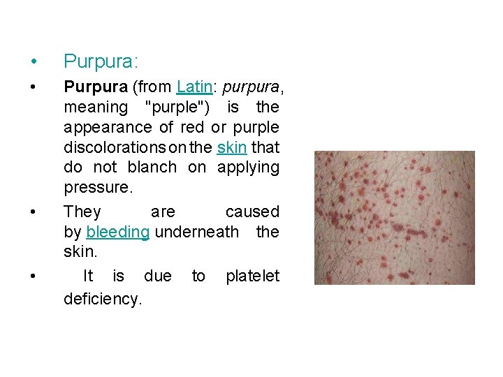  • Purpura: • Purpura (from Latin: purpura, meaning "purple") is the appearance of