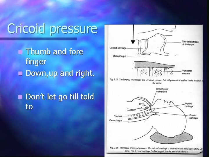 Cricoid pressure Thumb and fore finger n Down, up and right. n n Don’t