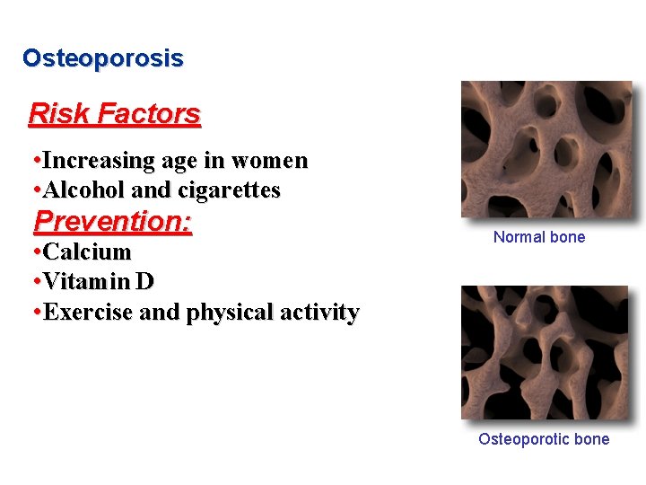 Osteoporosis Risk Factors • Increasing age in women • Alcohol and cigarettes Prevention: •