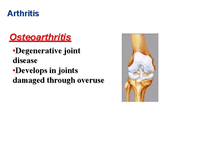 Arthritis Osteoarthritis • Degenerative joint disease • Develops in joints damaged through overuse 