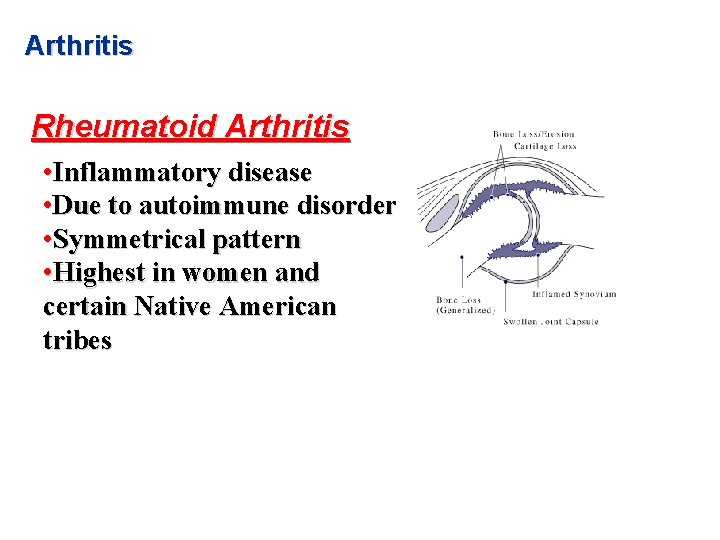 Arthritis Rheumatoid Arthritis • Inflammatory disease • Due to autoimmune disorder • Symmetrical pattern
