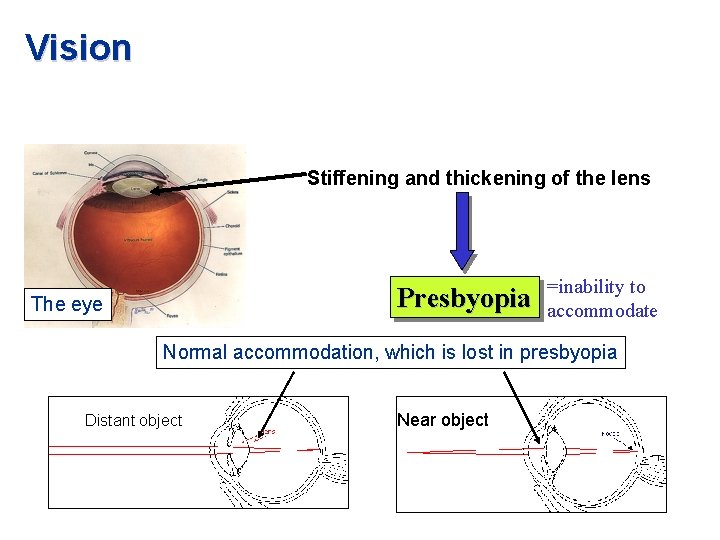 Vision Stiffening and thickening of the lens Presbyopia The eye =inability to accommodate Normal