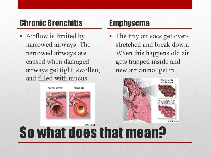 Chronic Bronchitis Emphysema • Airflow is limited by narrowed airways. The narrowed airways are
