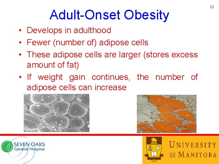 Adult-Onset Obesity • Develops in adulthood • Fewer (number of) adipose cells • These