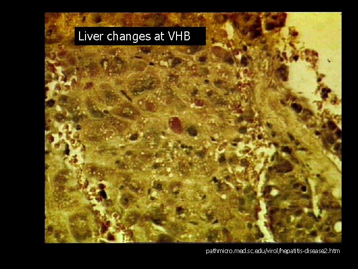 Liver changes at VHB pathmicro. med. sc. edu/virol/hepatitis-disease 2. htm 