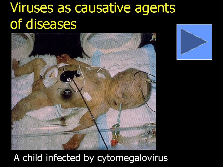 Viruses as causative agents of diseases A child infected by cytomegalovirus 