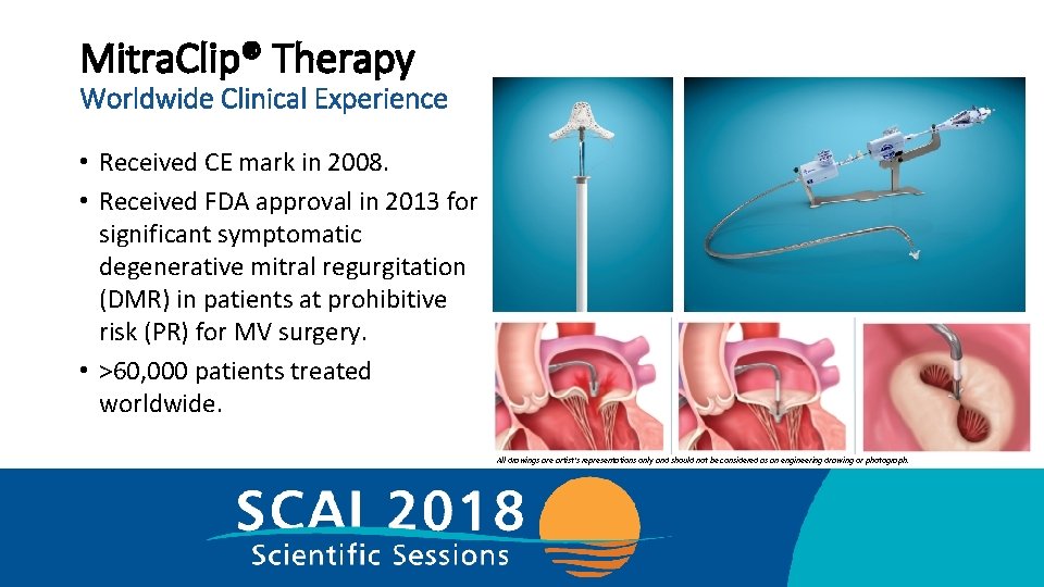 Mitra. Clip® Therapy Worldwide Clinical Experience • Received CE mark in 2008. • Received