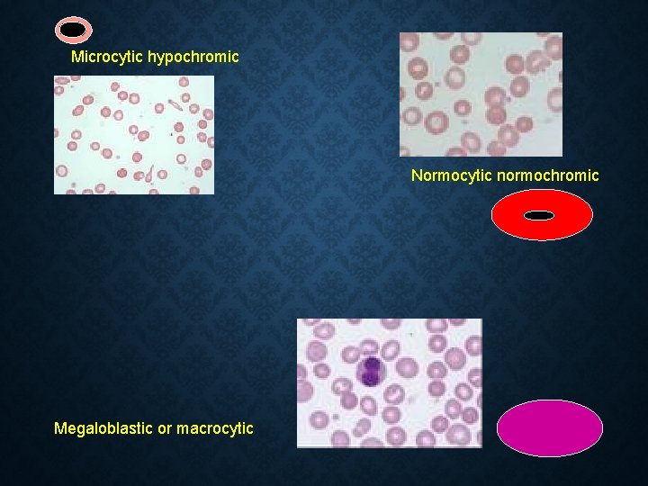 Microcytic hypochromic Normocytic normochromic Megaloblastic or macrocytic  Microcytic hypochromic Normocytic normochromic Megaloblastic or macrocytic