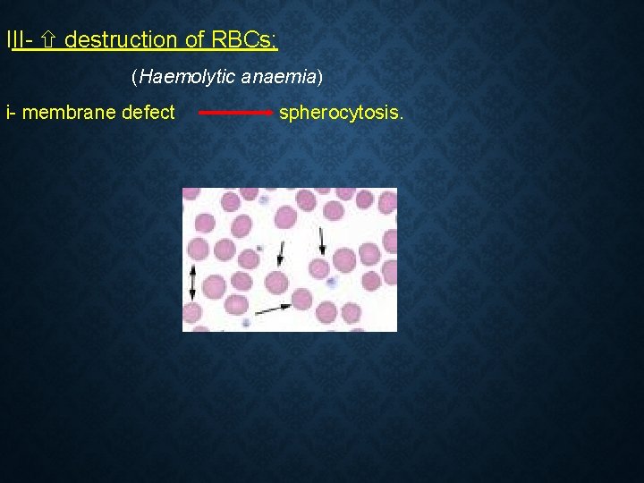 III- destruction of RBCs; (Haemolytic anaemia) i- membrane defect spherocytosis.  III- destruction of RBCs; (Haemolytic anaemia) i- membrane defect spherocytosis.