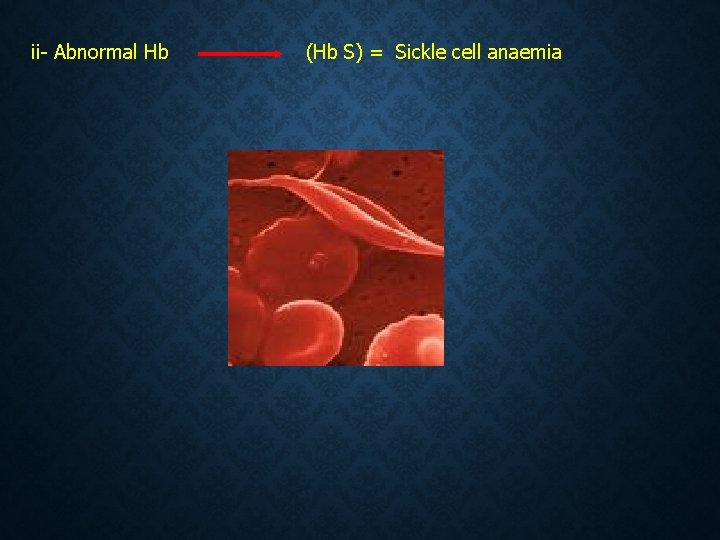ii- Abnormal Hb (Hb S) = Sickle cell anaemia  ii- Abnormal Hb (Hb S) = Sickle cell anaemia