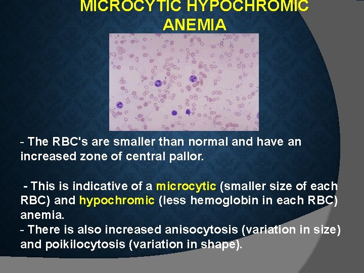 MICROCYTIC HYPOCHROMIC ANEMIA - The RBC's are smaller than normal and have an increased MICROCYTIC HYPOCHROMIC ANEMIA - The RBC's are smaller than normal and have an increased
