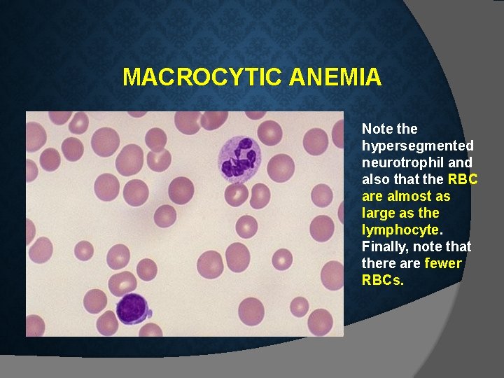 MACROCYTIC ANEMIA Note the hypersegmented neurotrophil and also that the RBC are almost as MACROCYTIC ANEMIA Note the hypersegmented neurotrophil and also that the RBC are almost as