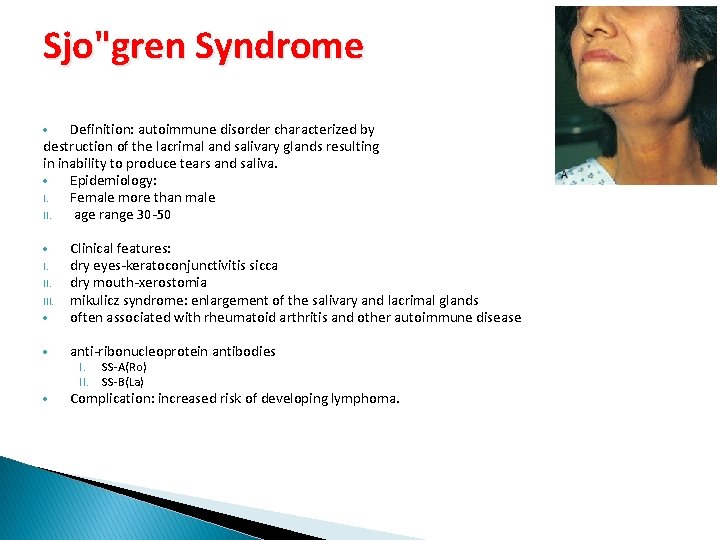 Sjo"gren Syndrome Definition: autoimmune disorder characterized by destruction of the lacrimal and salivary glands