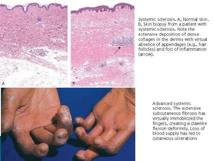 Systemic sclerosis. A, Normal skin. B, Skin biopsy from a patient with systemic sclerosis.