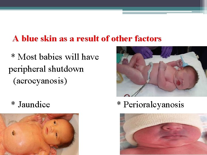 A blue skin as a result of other factors * Most babies will have