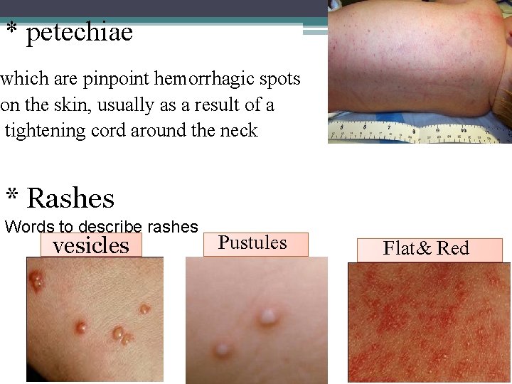 * petechiae which are pinpoint hemorrhagic spots on the skin, usually as a result