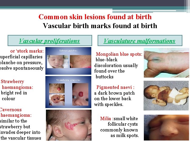 Common skin lesions found at birth Vascular birth marks found at birth Vascular proliferations