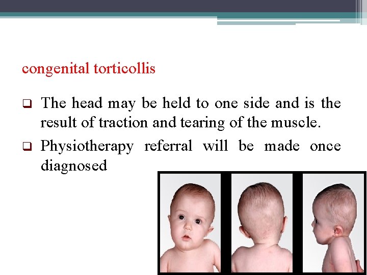 congenital torticollis q q The head may be held to one side and is