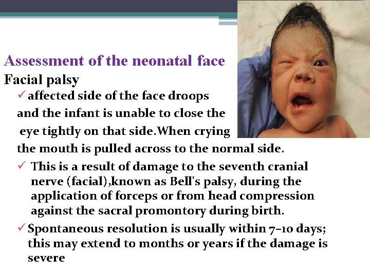 Assessment of the neonatal face Facial palsy ü affected side of the face droops