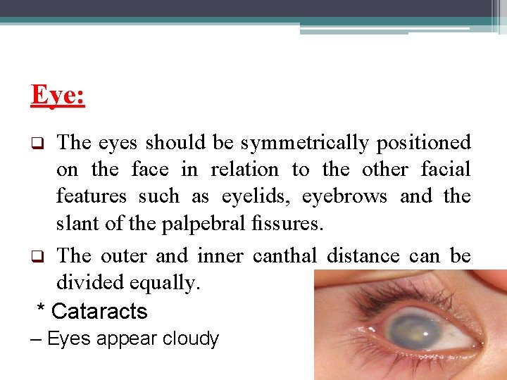 Eye: The eyes should be symmetrically positioned on the face in relation to the