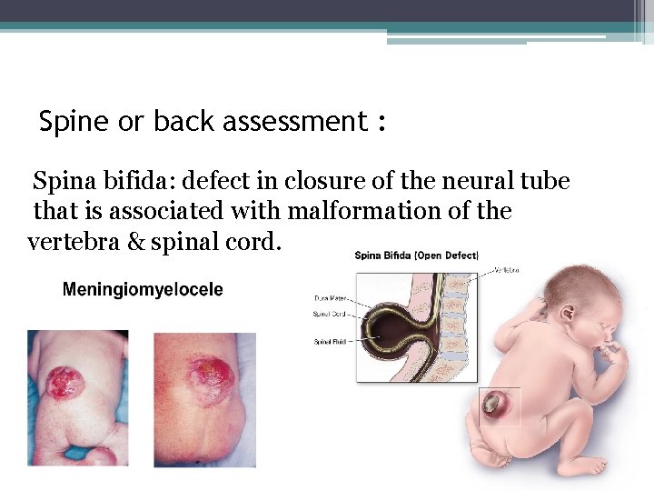 Spine or back assessment : Spina bifida: defect in closure of the neural tube