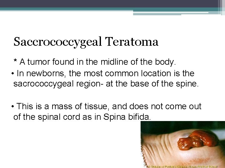 Saccrococcygeal Teratoma * A tumor found in the midline of the body. • In