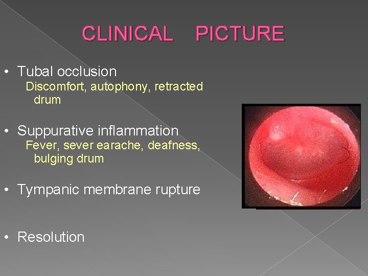CLINICAL PICTURE • Tubal occlusion Discomfort, autophony, retracted drum • Suppurative inflammation Fever, sever