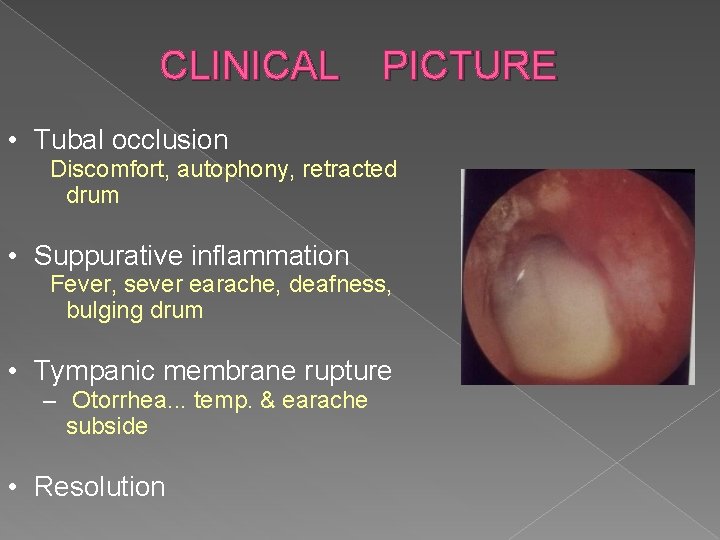 CLINICAL PICTURE • Tubal occlusion Discomfort, autophony, retracted drum • Suppurative inflammation Fever, sever