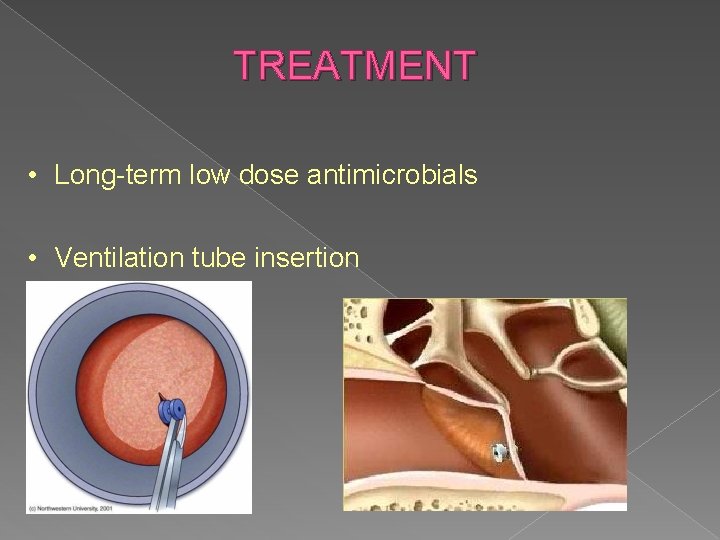 TREATMENT • Long-term low dose antimicrobials • Ventilation tube insertion 