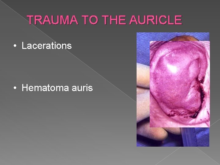 TRAUMA TO THE AURICLE • Lacerations • Hematoma auris 