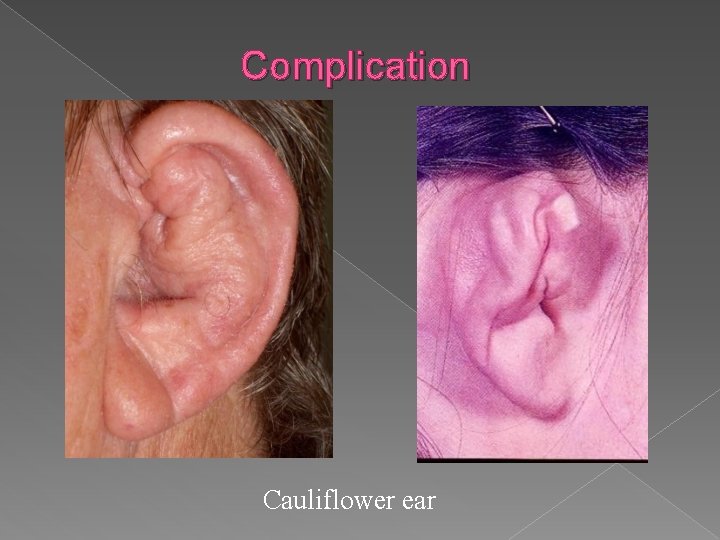Complication Cauliflower ear 