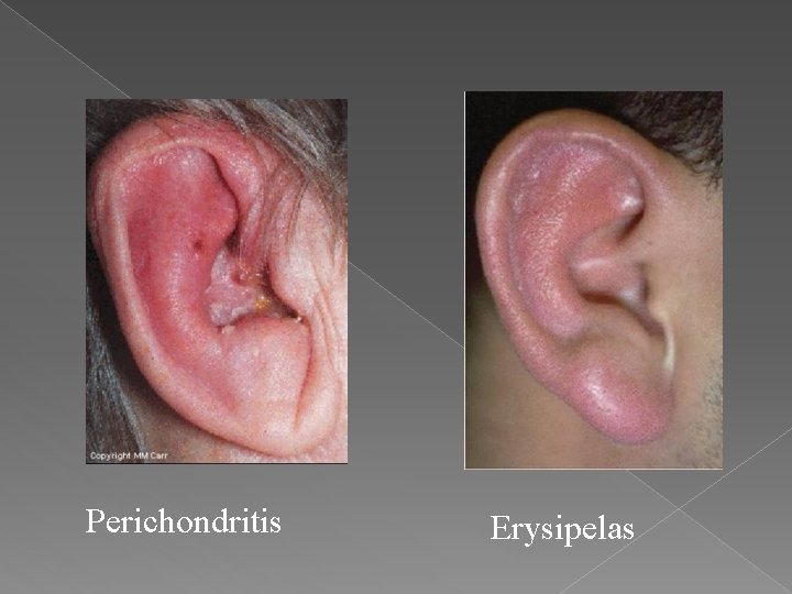 Perichondritis Erysipelas 