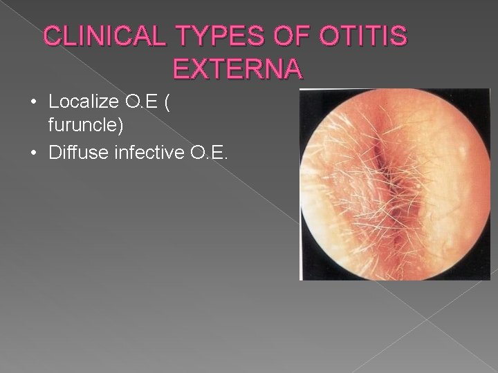 CLINICAL TYPES OF OTITIS EXTERNA • Localize O. E ( furuncle) • Diffuse infective