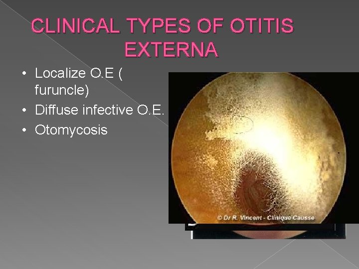 CLINICAL TYPES OF OTITIS EXTERNA • Localize O. E ( furuncle) • Diffuse infective