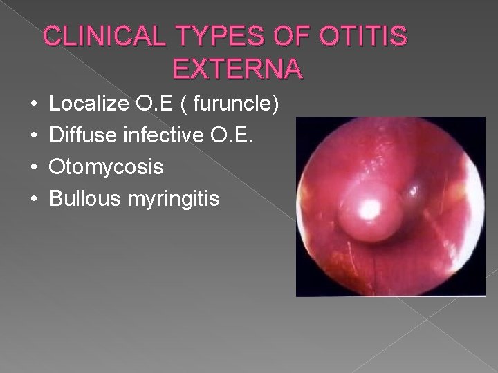 CLINICAL TYPES OF OTITIS EXTERNA • • Localize O. E ( furuncle) Diffuse infective