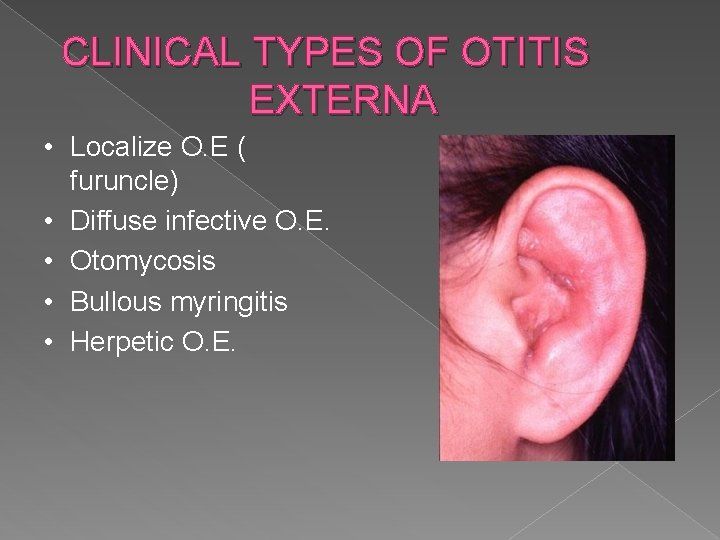 CLINICAL TYPES OF OTITIS EXTERNA • Localize O. E ( furuncle) • Diffuse infective