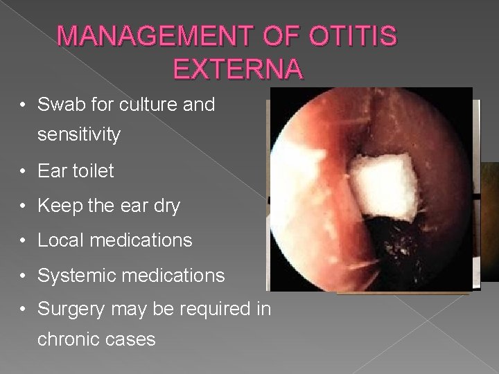 MANAGEMENT OF OTITIS EXTERNA • Swab for culture and sensitivity • Ear toilet •