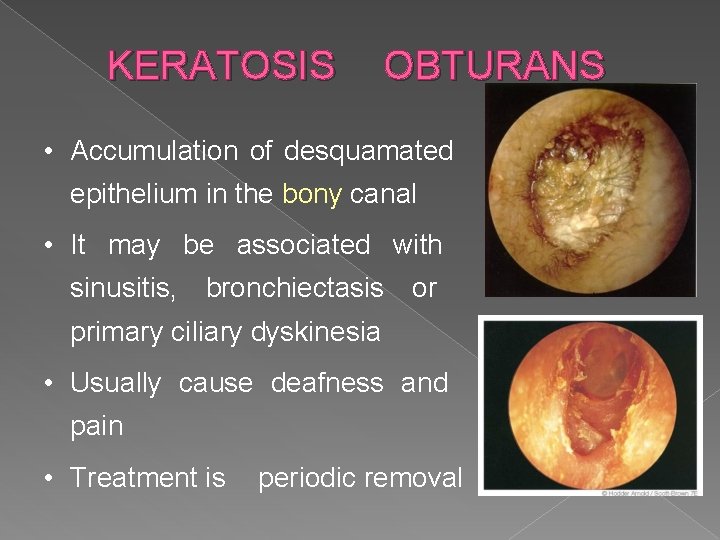 KERATOSIS OBTURANS • Accumulation of desquamated epithelium in the bony canal • It may