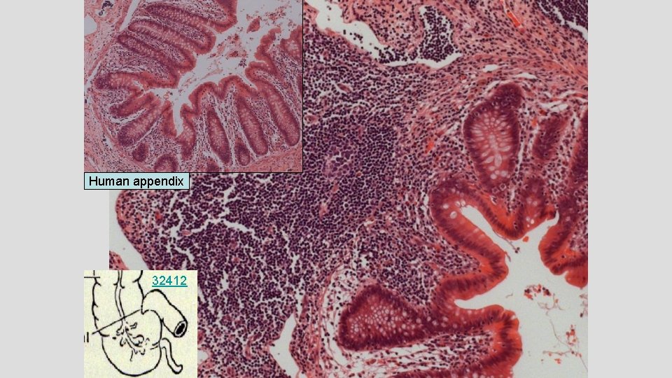 Human appendix 32412 
