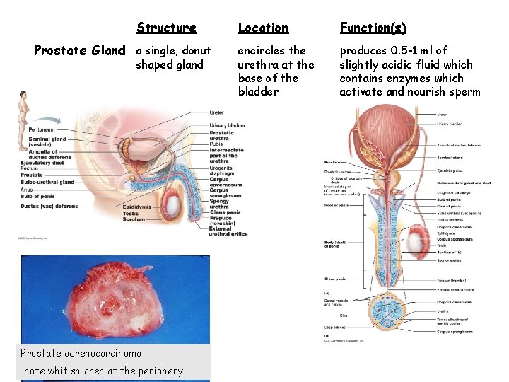 Structure Prostate Gland a single, donut shaped gland Prostate adrenocarcinoma note whitish area at