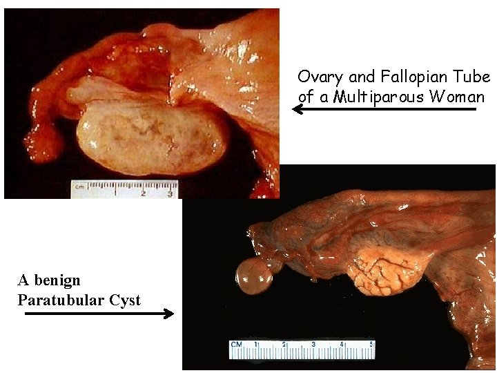 Ovary and Fallopian Tube of a Multiparous Woman A benign Paratubular Cyst 