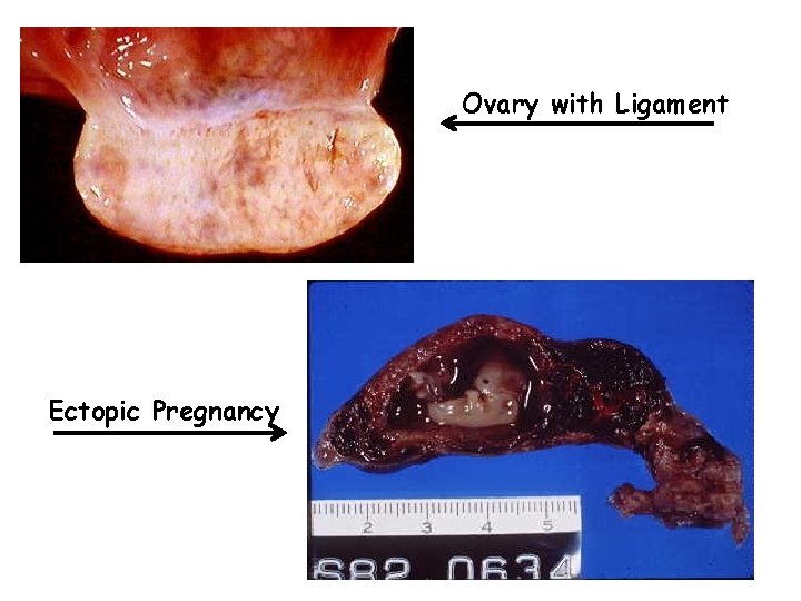 Ovary with Ligament Ectopic Pregnancy 