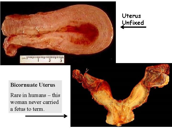 Uterus Unfixed Bicornuate Uterus Rare in humans – this woman never carried a fetus