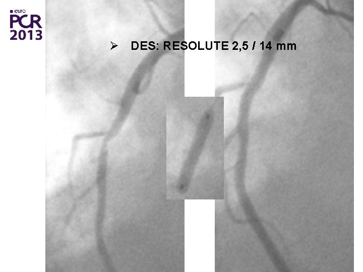 Ø DES: RESOLUTE 2, 5 / 14 mm 