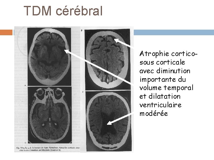 TDM cérébral Atrophie corticosous corticale avec diminution importante du volume temporal et dilatation ventriculaire