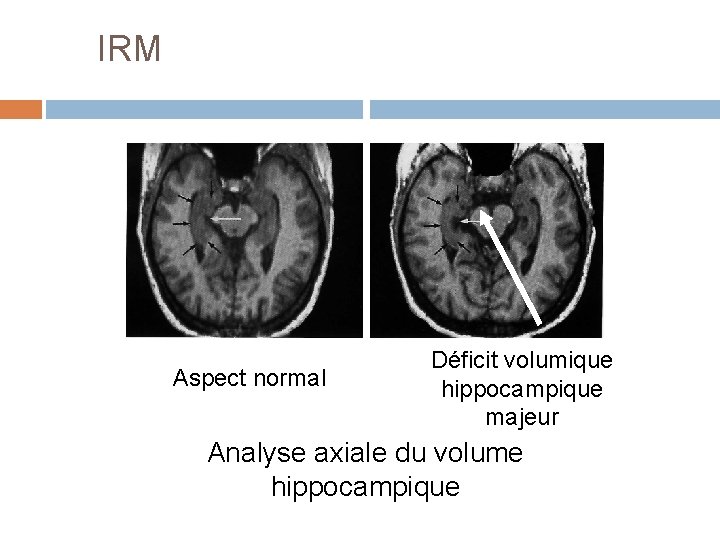 IRM Aspect normal Déficit volumique hippocampique majeur Analyse axiale du volume hippocampique 