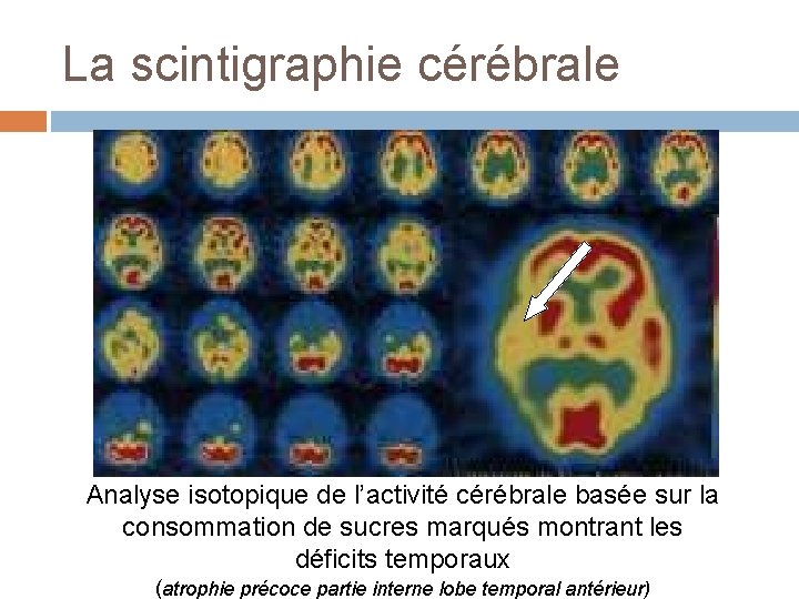 La scintigraphie cérébrale Analyse isotopique de l’activité cérébrale basée sur la consommation de sucres