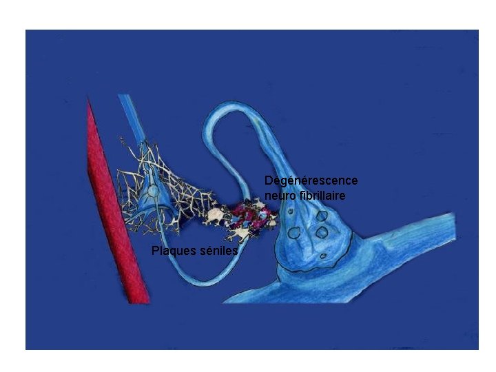 Dégénérescence neuro fibrillaire Plaques séniles 