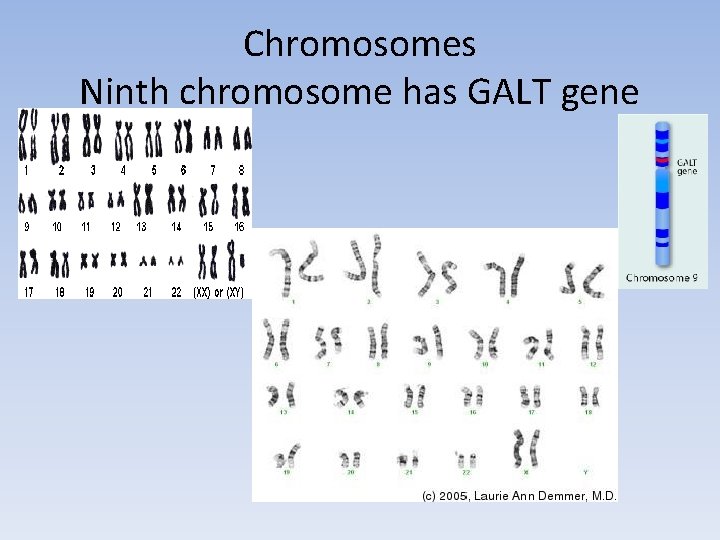 Chromosomes Ninth chromosome has GALT gene 